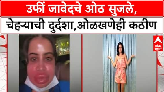 Urfi Javed Lip Fillers | उर्फी जावेदचे ओठ सुजले, ओळखणेही कठीण; लिप फिलर काढतानाचा व्हिडीओ