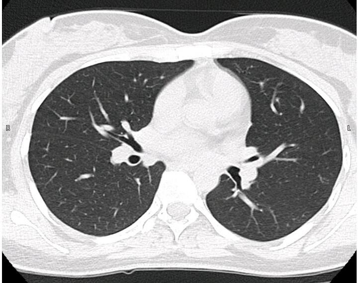 Coronavirus Autopsy Report : Coronavirus Autopsy Report Big News 400 Grams Lungs Like 4 Kg Denuded Lung X-rays કોરોનાથી મરનાર દર્દીનાં ફેફસાં કાળા પથ્થર જેવાં કડક થઈ ગયાં, વજન  400 ગ્રામથી વધીને 3 કિલો થયું, મેડિકલ રીપોર્ટથી લાગી જશે આઘાત
