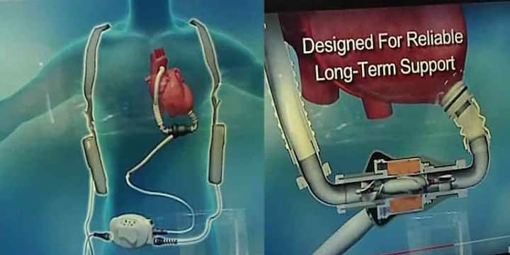 first artificial heart transplantation record for state, successfully done by Medica Superspeciality Hospital Artificial Heart Transplantation: রাজ্যে প্রথম কৃত্রিম হৃদযন্ত্র প্রতিস্থাপন, সাফল্য কলকাতার চিকিৎসকদের