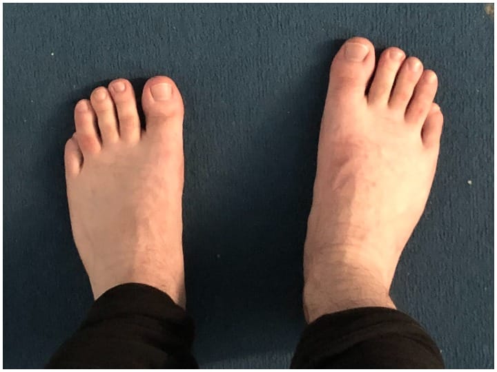 Swollen feet or legs: Know cause and when to meet doctor, is it harmless पांव या एड़ियों की सूजन, क्या ये नुकसानदेह है, वजह और डॉक्टर से मुलाकात की जरूरत को भी जानें