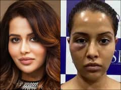 Bigg Boss Fame Raiza Wilson’s Facial Treatment Goes Wrong; Says She Was ‘Forced’ To Undergo Dermatological Procedure