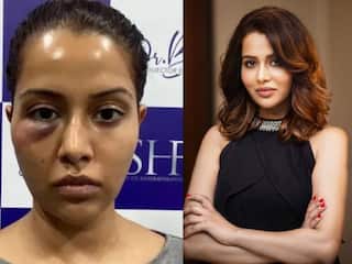 Raiza Wilson Face Allergy: एक्ट्रेस रायजा विल्सन ने डॉक्टर पर लगाया चेहरा खराब करने का आरोप, बोलीं- जबरदस्ती किया ट्रीटमेंट