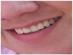 रिसर्च में दावा, पायरिया से पीड़ित कोरोना मरीजों में गंभीर रूप से बीमार होने और मौत का खतरा ज्यादा