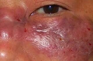 ગુજરાતમાં કોરોના બાદ જોવા મળી રહ્યો છે આ ખતરનાક રોગ, જાણો બચવા શું કરશો