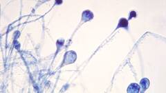 Mucormycosis च्या औषधांसाठी धावाधाव? आजार बरा करणाऱ्या औषधांच्या तुटवड्याची भीती : स्पेशल रिपोर्ट