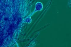 ગુજરાતના આ શહેરમાં મ્યુકરમાઈકોસિસના કેસમાં વઘારો, રોગના છે આ 4 સ્ટેજ, પહેલા સ્ટેજમાં જ ચેતી જજો નહિંતર...