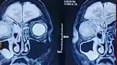 Uttar Pradesh में अब ब्लैक फंगस का हमला, लखनऊ-कानपुर में मिले मरीज