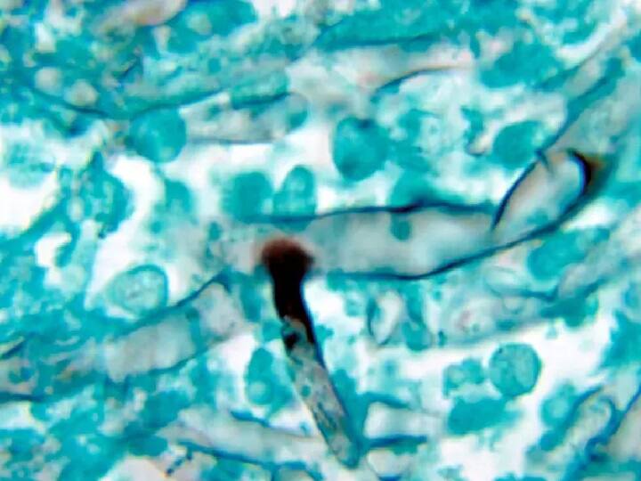27 black fungus cases in Haryana, 5 this week அச்சமூட்டும் பூஞ்சைத் தொற்று: ஹரியானாவில் 5 வாரங்களில் 27 பேர்  பாதிப்பு!