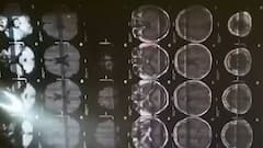 Corona Crisis: Panel of Doctors explains how to be safe from Black fungus