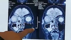 Black Fungus : Black Fungus से जुड़े हर सवाल का जवाब...जानें ब्लैक फंगस के बारे में