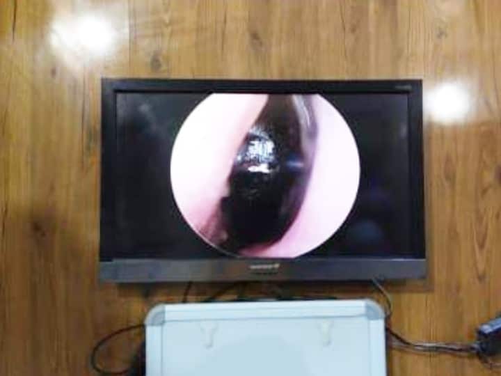 First Black fungus patient found in Sitamarhi and referred to Patna for better treatment ann बिहारः सीतामढ़ी में मिला ब्लैक फंगस का पहला मरीज, बेहतर इलाज के लिए पटना रेफर