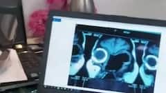 Black Fungus के बाद अब White Fungus का भी अटैक, जानिए क्यों है खतरनाक?