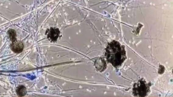 Black Fungus Infection: 'কোভিড একমাত্র কারণ নয়', ব্ল্যাক ফাঙ্গাস সংক্রমণ প্রসঙ্গে জানাল রাজ্য স্বাস্থ্য দফতর