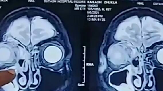 ब्लैक फंगस के बाद 'सफेद मौत'! देखिए मास्टर स्ट्रोक का फुल एपिसोड