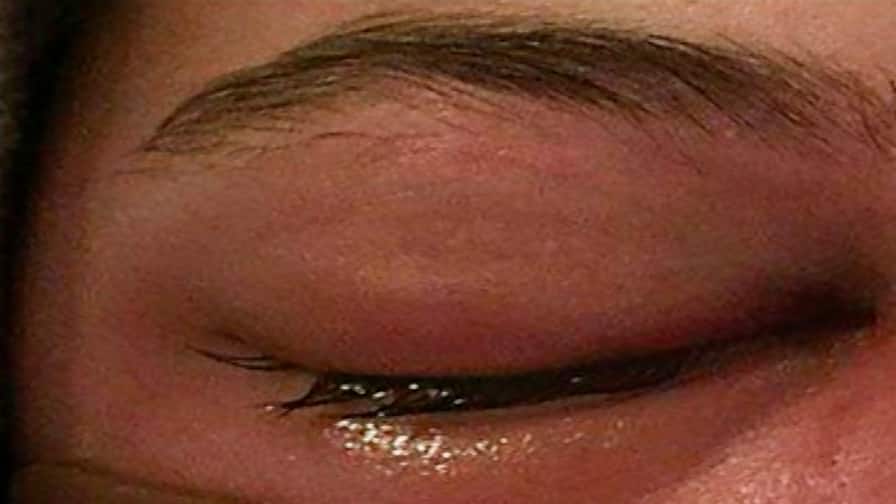 India reports 11,717 mucormycosis cases, 29K more Amphotericin vials allocated মিউকরমাইকোসিসে আক্রান্তের সংখ্যা ১২ হাজার ছুঁইছুঁই, ওষুধ বরাদ্দ কেন্দ্রের