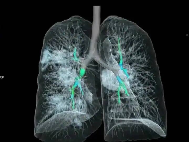 Along with medicines, post covid patients will increase their lung function through yoga ann UP News: पोस्ट कोविड मरीजों के लंग्स के लिए दवा के साथ मिलेगी योग की डोज, KGMU और बलरामपुर अस्पताल में मिलेगा इलाज