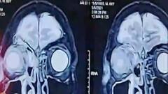 Black Fungus को देश के 5 राज्यों ने घोषित किया महामारी, दवाईयों की भी किल्लत