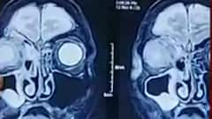 Black Fungus ব্ল্যাক ফাঙ্গাস সংক্রমণ এড়াতে কী করা উচিত আর কী নয়, নতুন নির্দেশিকা জারি রাজ্যের