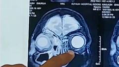 Black Fungus के बाद अब व्हाइट फंगस की एंट्री, UP में इस जगह मिला पहला केस