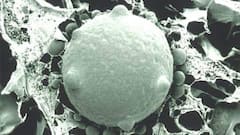 White Fungus Cases Reported In Several States - Know Symptoms & Who Are At Risk