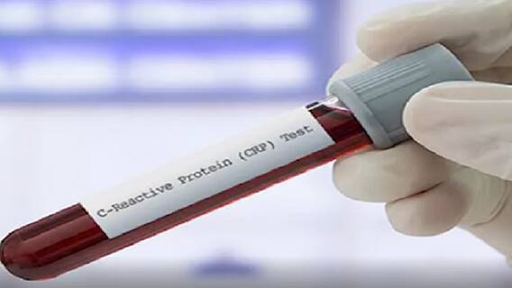 જાણો શું હોય છે CRP ટેસ્ટ, કોરોના પોઝિટિવ લોકો માટે શા માટે જરૂરી છે?