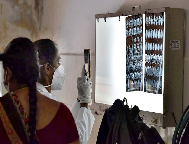 Mucormycosis is a serious but rare fungal infection caused by a group of molds called mucormycetes that has been developing in Covid-19 patients. (PTI Photo)