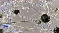 Black Fungus: কলকাতায় আরও এক মিউকরমাইকোসিস আক্রান্তের হদিশ