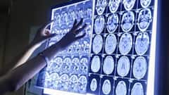 UP में Black Fungus के बाद White Fungus की दस्तक, Ghaziabad में वाइट फंगस के 7 मरीज मिले