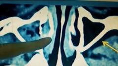 બ્લેક ફંગસના કેસમાં કયા રાજ્યો રહ્યા પ્રથમ અને બીજા ક્રમે, અન્ય કયા રાજ્યોએ જાહેર કરી મહામારી?