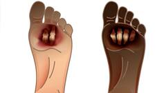 Gangrene : गॅंगरिन म्हणजे काय? कोरोनामुक्त रुग्णांना कशामुळे होतो हा आजार? गॅंगरिनवर काय उपचार आहेत?