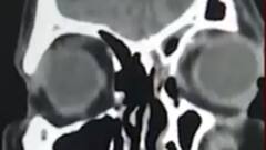 Lucknow में होम आइसोलेशन और Non-COVID मरीजों को भी हो रहा Black Fungus