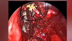 Black और White Fungus के बाद अब Yellow Fungus का खतरा, Ghaziabad में मिला पहला केस | Coronavirus