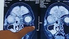 अब आया सबसे ‘खतरनाक’ फंगस!