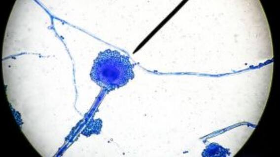 Black Fungus: নতুন করে আক্রান্ত ৫, বাংলায় মিউকরমাইকোসিসে আক্রান্তের সংখ্যা বেড়ে ১২