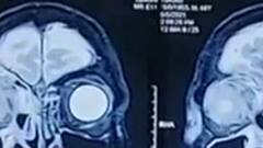 UP में कहर बरपा रहा है 'Black Fungus', प्रदेश में आंकड़ा 700 के पार