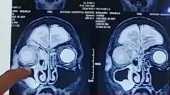 कोरोना मरीज की छोटी और बड़ी आंत में White Fungus के कारण हुआ छेद | मास्टर स्ट्रोक