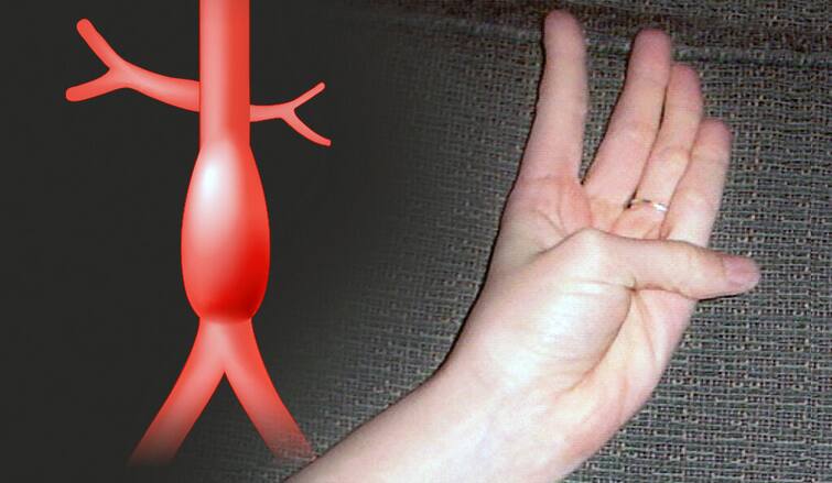 thumb-test-heart-condition-researchers suggest this  simple test ਅੰਗੂਠਾ ਮੋੜ ਕੇ ਕਰੋ ਦਿਲ ਦੇ ਗੰਭੀਰ ਰੋਗਾਂ ਦੀ ਆਸਾਨੀ ਨਾਲ ਜਾਂਚ, ਪੜ੍ਹੋ ਤਾਜ਼ਾ ਖੋਜ ਦੇ ਨਤੀਜੇ