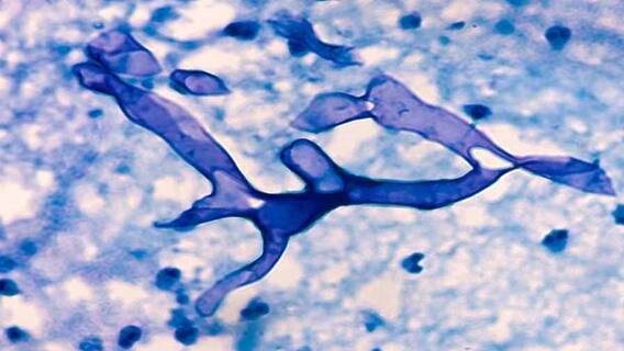 Mucormycosis: রাজ্যে উদ্বেগ বাড়াচ্ছে মিউকরমাইকোসিস, আক্রান্তের সংখ্যা বেড়ে ১৩