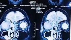 Uttarakhand: ब्लैक फंगस के बढ़ते मामले बढ़ा रहे हैं चिंता, देहरादून में सबसे ज्यादा 181 केस