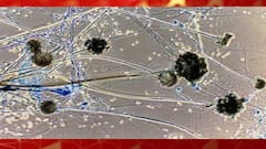 Mucormycosis: রাজ্যে মিউকরমাইকোসিসে আক্রান্তের সংখ্যা বেড়ে ২৪