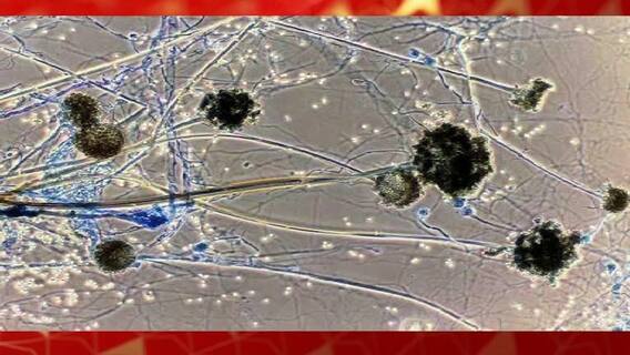 Mucormycosis: রাজ্যে মিউকরমাইকোসিসে আক্রান্তের সংখ্যা বেড়ে ২৪