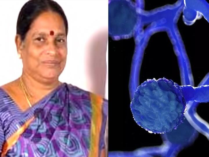 First death due to black fungus in Pondicherry கருப்பு பூஞ்சைத்தொற்று காரணமாக புதுச்சேரியில் ஒருவர் உயிரிழப்பு