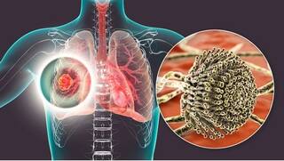 Aspergillosis Fungus: ਕੋਰੋਨਾ ਤੋਂ ਠੀਕ ਹੋਣ ਤੋਂ ਬਾਅਦ ਹੁਣ ਇੱਕ ਹੋਰ ਨਵੇਂ ਫੰਗਲ ਇਨਫੈਕਸਨ ਹੋ ਰਿਹਾ ਘਾਤਕ, ਜਾਣੋ ਕੀ ਹਨ ਲੱਛਣ