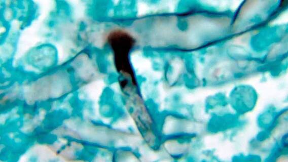 Mucormycosis: সরকারি হাসপাতালে মিউকরমাকোসিসের চিকিৎসায় ব্যবহৃত জীবনদায়ী ওষুধ অমিল, স্বাস্থ্যভবনে চিঠি