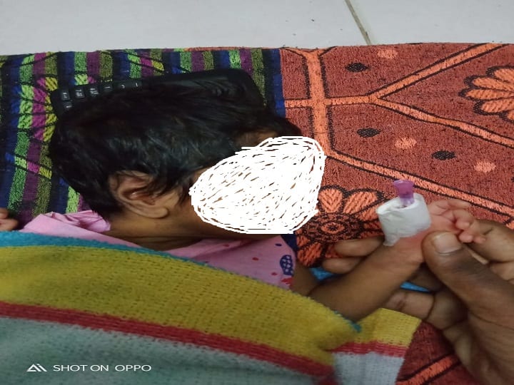 Nurse cut finger of 14-year-old child in Thanjavur 14 நாள் குழந்தை:  பேண்டேஜ் கழற்ற வந்த நர்ஸ்; கை விரலை துண்டித்த பரிதாபம்!