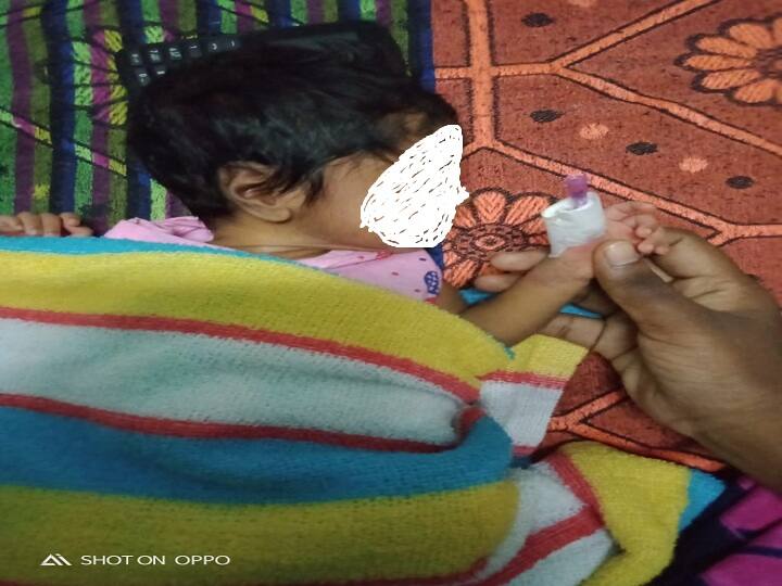 Thanjavur born child Finger amputation issue, dean Order to inquiry பச்சிளம் குழந்தை விரல் துண்டான விவகாரம்: விசாரணைக்கு உத்தரவு