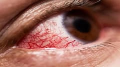 Palghar Mucormycosis Death : पालघर जिल्ह्यात म्युकरमायकोसिसच्या पाच रुग्णांचा मृत्यू