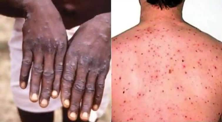 US Confirms 1st Case Of Monkeypox Man Who Recently Travelled To Canada Monkeypox Case in US: ধরা পড়ল আমেরিকাতেও, প্রকোপ কানাডা, ইউরোপেও, মাঙ্কিপক্স কী জেনে নিন