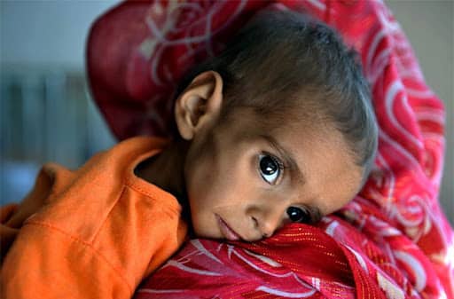 Fragile X Syndrome in India: India Stares Down The Barrel As Fragile X Syndrome Affects 4 Lakh Children  Need to Know About This Rare Disorder India Stares Down The Barrel As Fragile X Syndrome Affects 4 Lakh Children