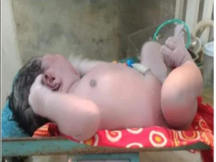 Assam newborn baby weighs 5.2 kgs at birth it state record Assam Newborn Baby : அசாமில் 5.2 கிலோ எடையுடன் பிறந்த ஆண் குழந்தை